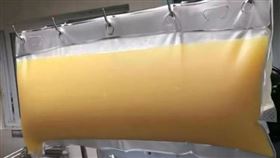 137公斤男體檢！醫師「血液過濾」完嚇傻：抽出2升油漿（圖／翻攝自極目新聞微博）