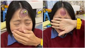 額頭拔罐提神？妹實測慘「腫1包」　網見照笑爆：這個會紅（圖／網友亞聖提供）