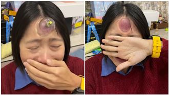 實測額頭拔罐提神！嫩妹超慘下場曝光