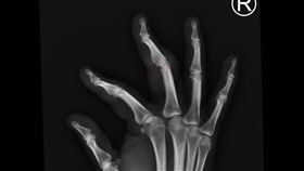  ▲林女右手X光片，中指關節骨頭被侵蝕，缺了一小塊。（圖／部立彰化醫院提供）