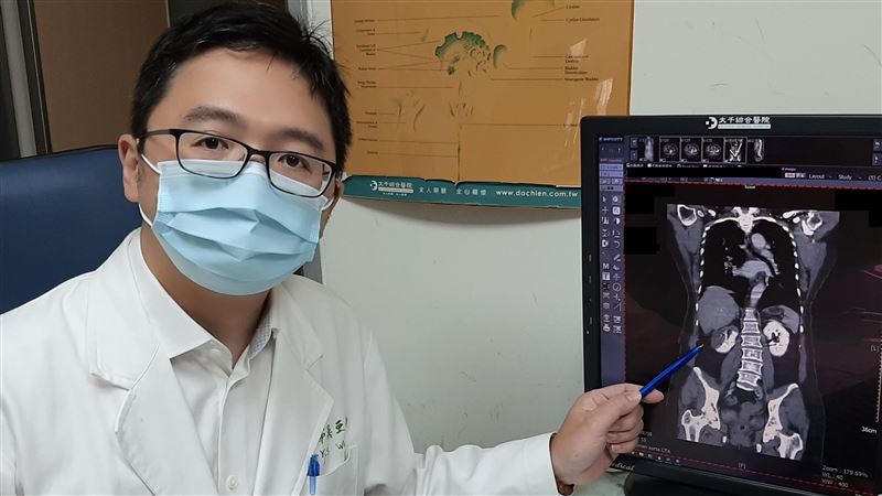 腰痛誤以為腎結石  結果竟是腎中風