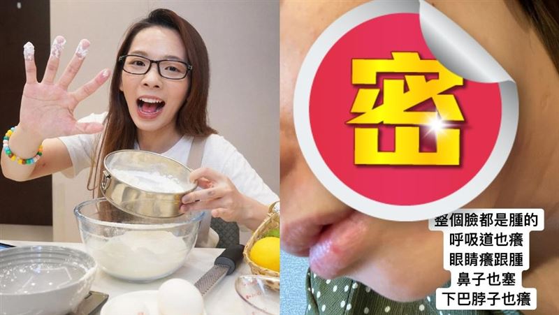 滴妹滿臉浮腫！吃藥沒用：呼吸道也癢
