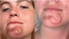 激吻「鬍子男」正妹慘下巴潰爛！網點1關鍵：比馬桶蓋還髒（圖／翻攝自TikTok / @hannahwitts42）