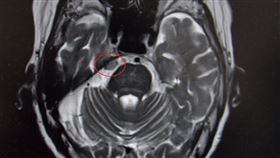 不明原因臉痛　核磁共振驚見腦腫瘤(台中醫院提供)