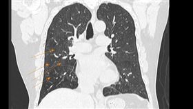許人文研判病患罹患過敏性肺泡炎，抽絲剝繭後發現，原來害她反覆發作氣喘的元兇就是麵粉，幸好及時發現，避免造成肺纖維化，也就是俗稱的菜瓜布肺。（圖／長安醫院提供）