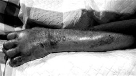 老翁洗蝦被刺到！手臂劇痛「整支壞掉」　最後截肢才保命（圖／翻攝自廣州日報微博）