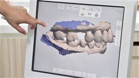 ▲林太太接受齒雕方式進行牙體復形，在保有美觀度下同時提升耐咬度。