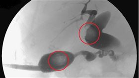 膽結石(南投醫院)