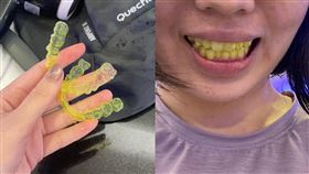 牙套,咖哩,泛黃,12萬,牙醫(翻攝自 爆廢公社公開版)