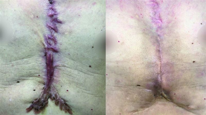 術後傷口發癢還「隆起」　蟹足腫上身