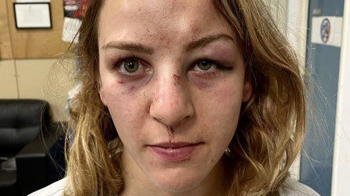 奧運金牌遭施暴！柔道女將頂熊貓眼