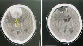 朱彥澤醫師/腦瘤(長安醫院提供)
