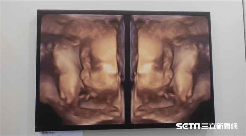 突走了　母曬超音波：謝謝你曾當我孩