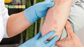 目前免疫調節劑主要有三種，成效皆良好，但仍有副作用，包含肝功能異常、血脂異常、腎功能異常或影響血壓等，上述情形也進而促使生物製劑問世，在維持成效同時，大幅改善副作用問題。