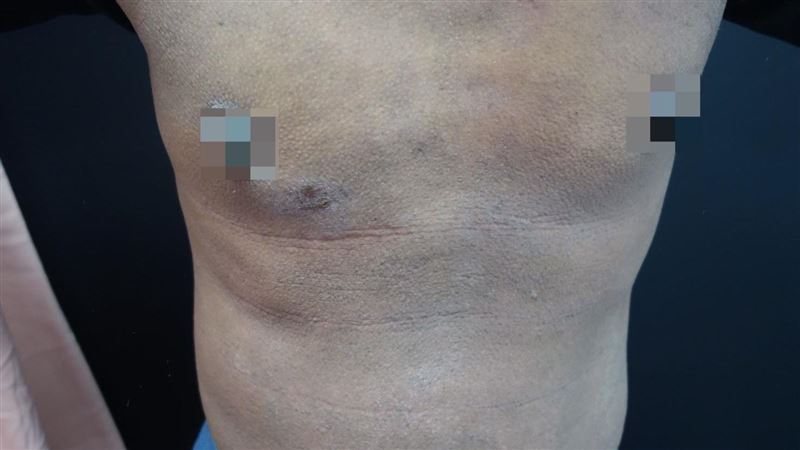 異位性皮膚炎搔癢流湯　男老師被嫌臭