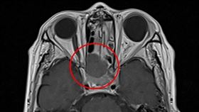 鼻竇黏液囊腫釀視神經病變　老婦一覺醒來視力剩1／10(慈濟醫院提供)