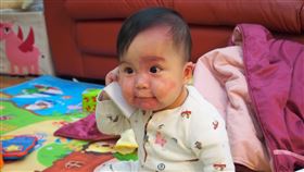 禹岑，血管瘤，血管畸形（圖／陽光基金會提供）