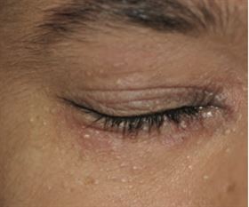 粟粒腫常出現在眼周，裡面混合著油脂及老廢角質，可能與清潔不完全有關(台中醫院)