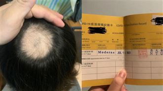 24歲女打莫德納慘禿頭　醫師曝原因