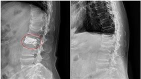 王女士治療前後X光影像（圖／亞大醫院提供）