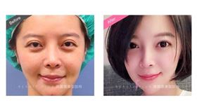 ▲藝人趙心姸進行雙眼修復。（圖／綺麗嘉美型診所提供）