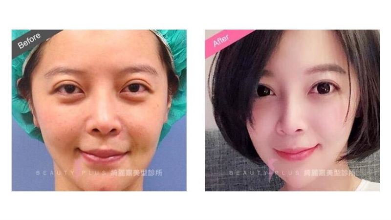 眼睛常無神？把握過年前「微調」時機