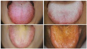 擷取自《現代臨床望舌》作者羅綸謙 、蔣依吾 （ 知音出版社）授權，其他新聞勿用