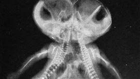 ▲連體嬰在科學還不是那麼進步的時候，命運多半是很悲慘的。（圖／翻攝自維基百科）