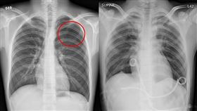 氣胸對比照（圖／台北慈院提供）