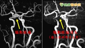 「腦動脈瘤如同腦中未爆彈！」許育弘醫師強調，腦動脈瘤可怕之處為位於腦部深處，絕大多數病患在破裂前並無症狀，因此都不自知。當動脈瘤越大，血管壁就越薄，也越容易破裂。(圖/許育弘醫師提供)
