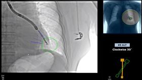肺腺癌(馬偕醫院提供)