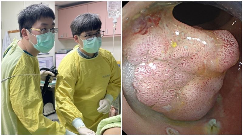 好險！早期大腸癌　內視鏡切除免開刀