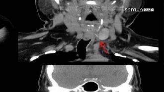 婦喉痛就醫　見2.3公分魚刺穿食道