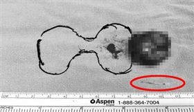 魚刺,喉嚨,甲狀腺,刺穿,生命危險