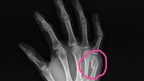 拳擊手骨折。示意圖。（圖／翻攝自來講兒科急診的543-吳昌騰醫師）