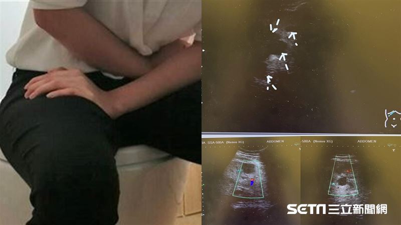 20多歲男大腸癌末　醫曝7高風險群