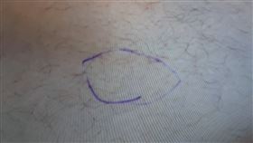 陳先生因疫情拖延病情，導致就診時腫瘤已增大為6公分(圖中藍圈處)，並侵襲到肌肉層。（圖／大千綜合醫院提供）