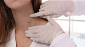 開運痣相,惡痣,善痣,福氣（示意圖／pixabay）