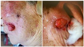 皮膚癌(安南醫院)