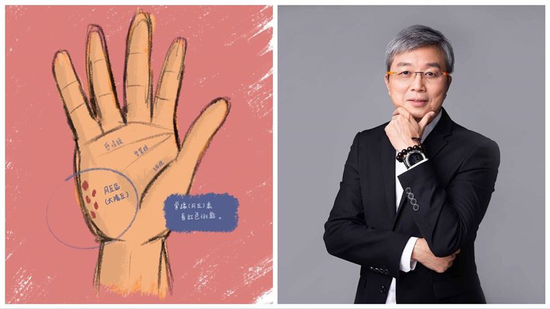 快看手心！中醫：「肝癌掌紋」長這樣