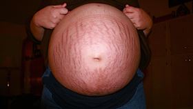 懷孕妊娠紋示意圖（圖／Pixabay）