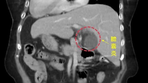 8旬嬤腹痛就醫　發現竟是「鏡面人」