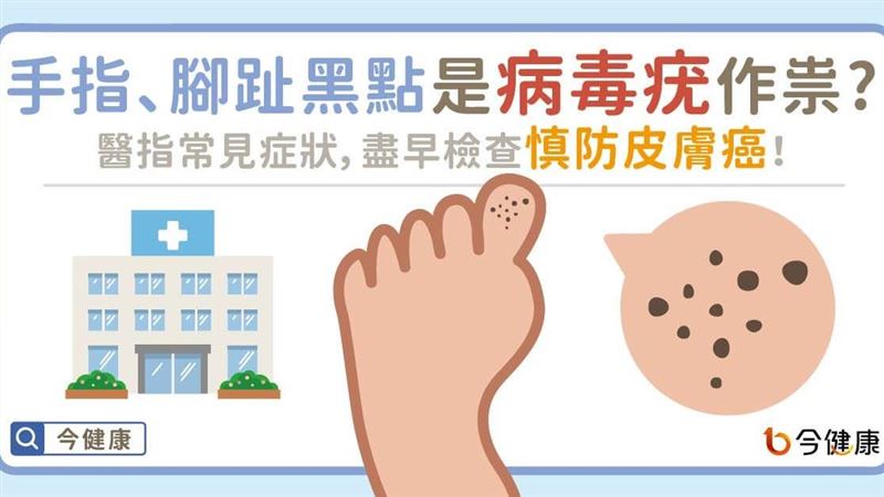 常見手指、腳趾黑點　是病毒疣作祟？