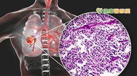 鄭企峰呼籲，面對小細胞肺癌的威脅，最重要的就是「預防」，要避免暴露在危險因子當中，臨床研究發現有八成以上的患者與抽菸有相當大的關聯性，因此有抽煙的人務必要「戒菸」。