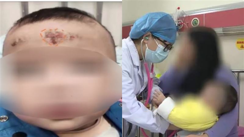 十月大孫女狂咳　婆婆竟刮痧害臉潰爛
