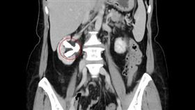 林女士右側腎臟竟出現長達6公分的鹿角狀結石。（圖／亞大醫院提供）