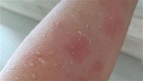 門諾醫院,皮膚科,蔡凱淇,蕁麻疹,服藥,擦藥
圖／翻攝自門諾醫院官網