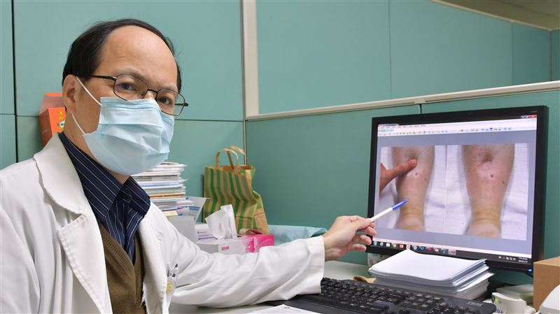 腳腫「按壓像麵粉糰」　竟是腎癌末期