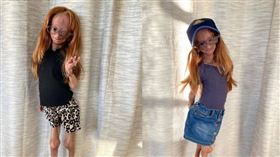 早衰,早年衰老症候群,Youtube,罕病少女,