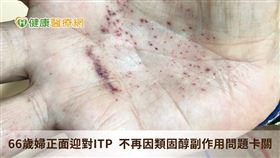 美國血液學會建議，成年的ITP患者若無症狀，但血小板數量少於3萬(/uL)，就要開始接受治療。